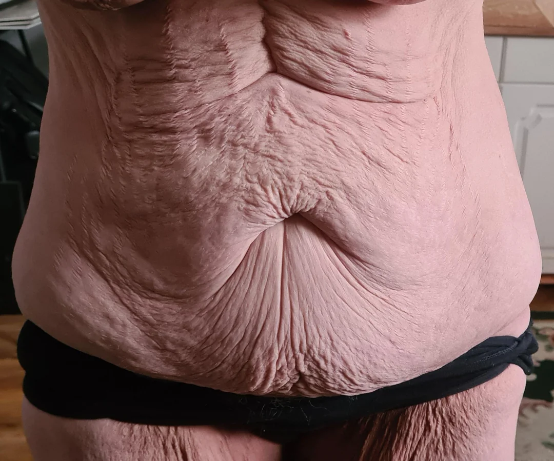 Loose skin after weight loss